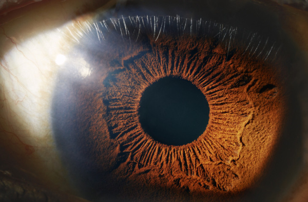 Read more about the article Who needs treatment for ocular hypertension?